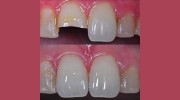 Icon Dental Implants